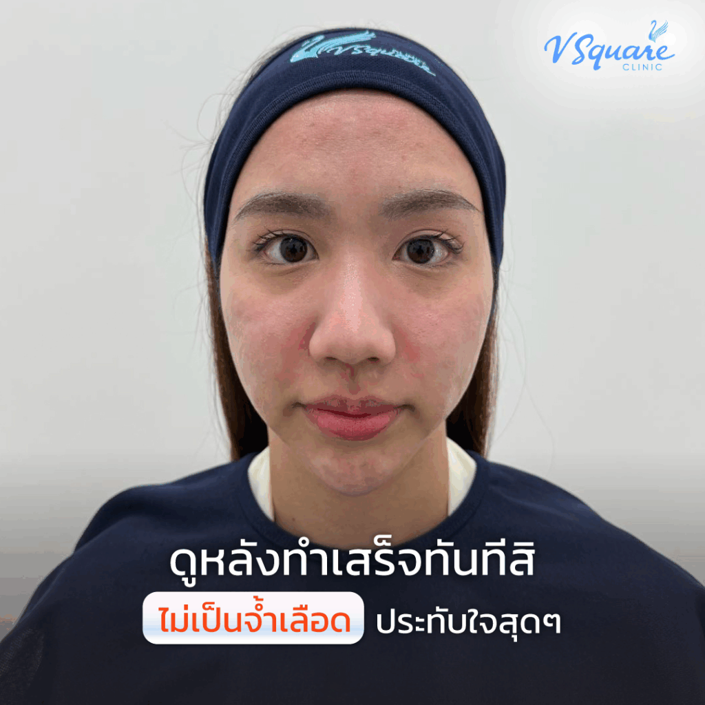 หลังทำเลเซอร์หน้า_คุณเนย