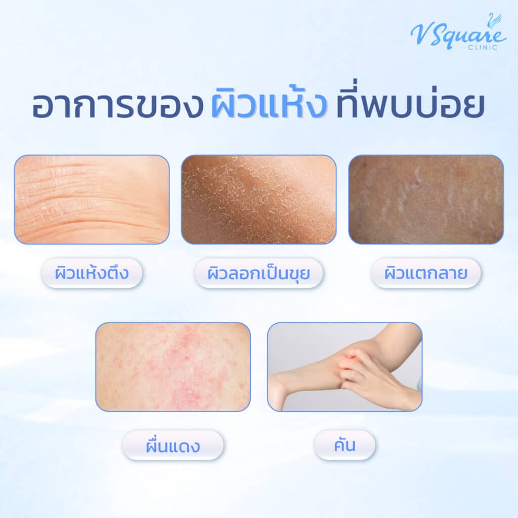 อาการผิวแห้ง