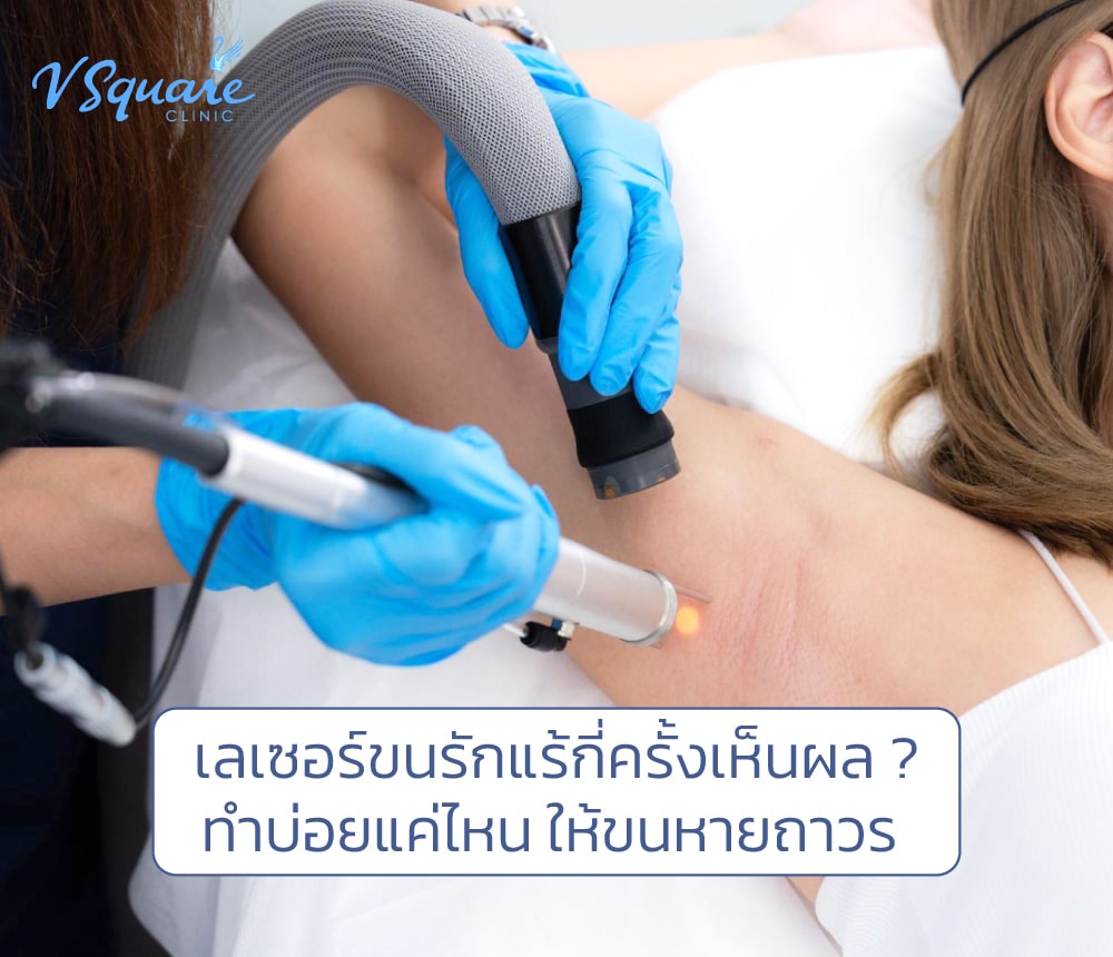 เลเซอร์ขนรักแร้กี่ครั้งเห็นผล