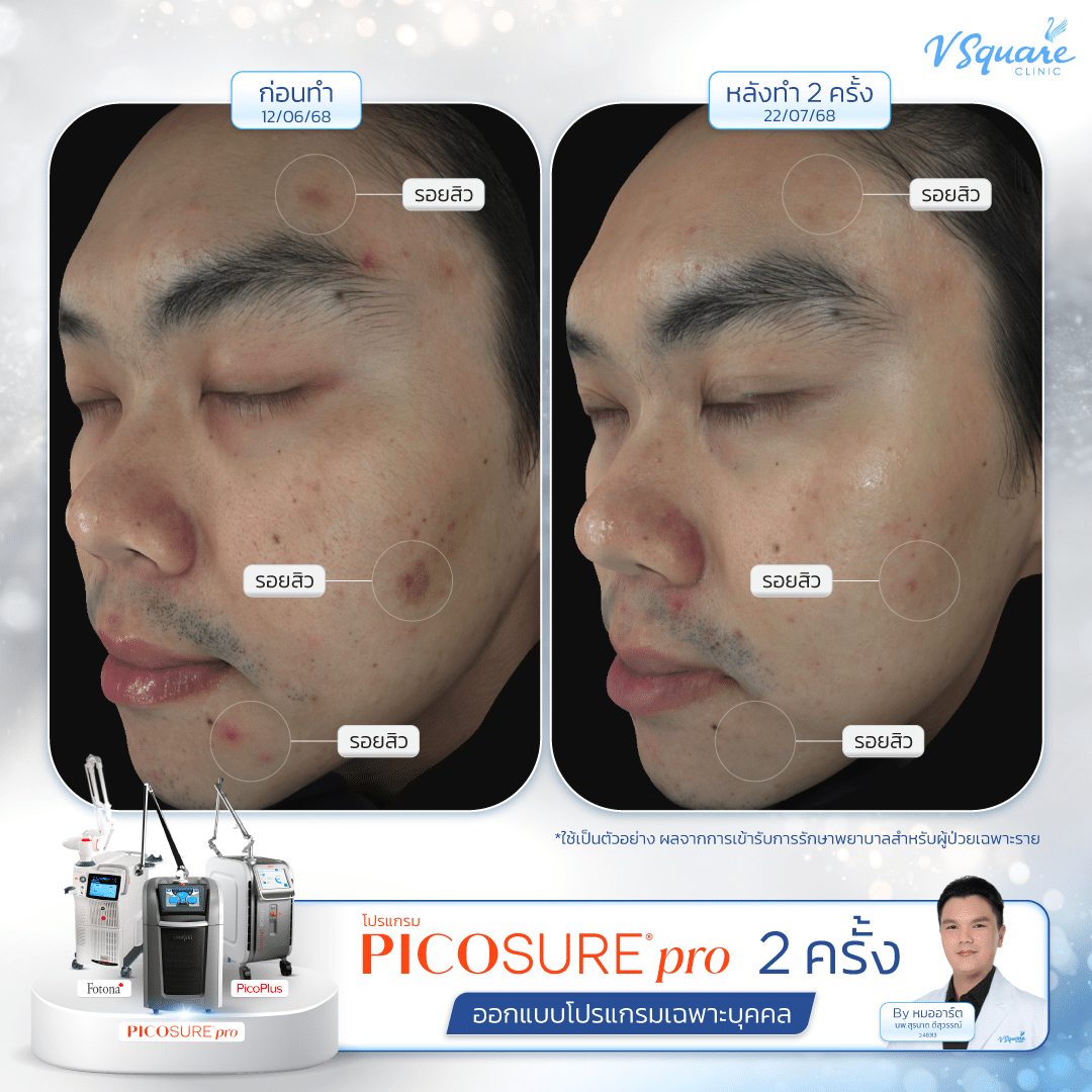 Pico Laser รีวิว ลดรอยสิว