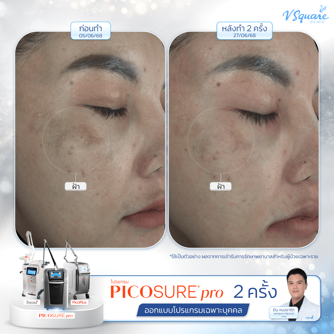 Pico ฝ้า รีวิว โดย นพ.สุรนาถ ดีสุวรรณ์