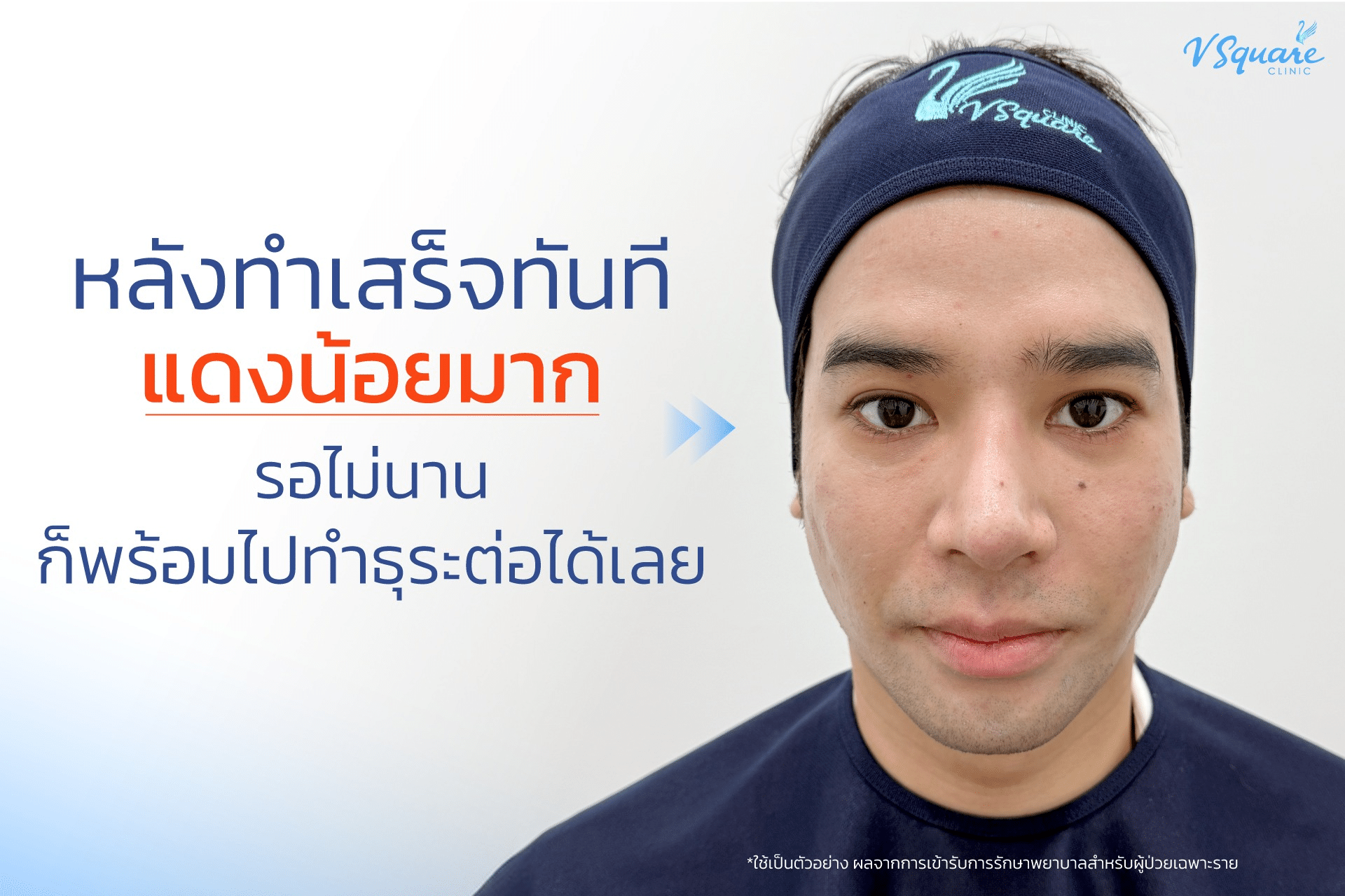 ทำ Pico Laser รีวิวหลังทำ_คุณปอนด์ปลื้ม
