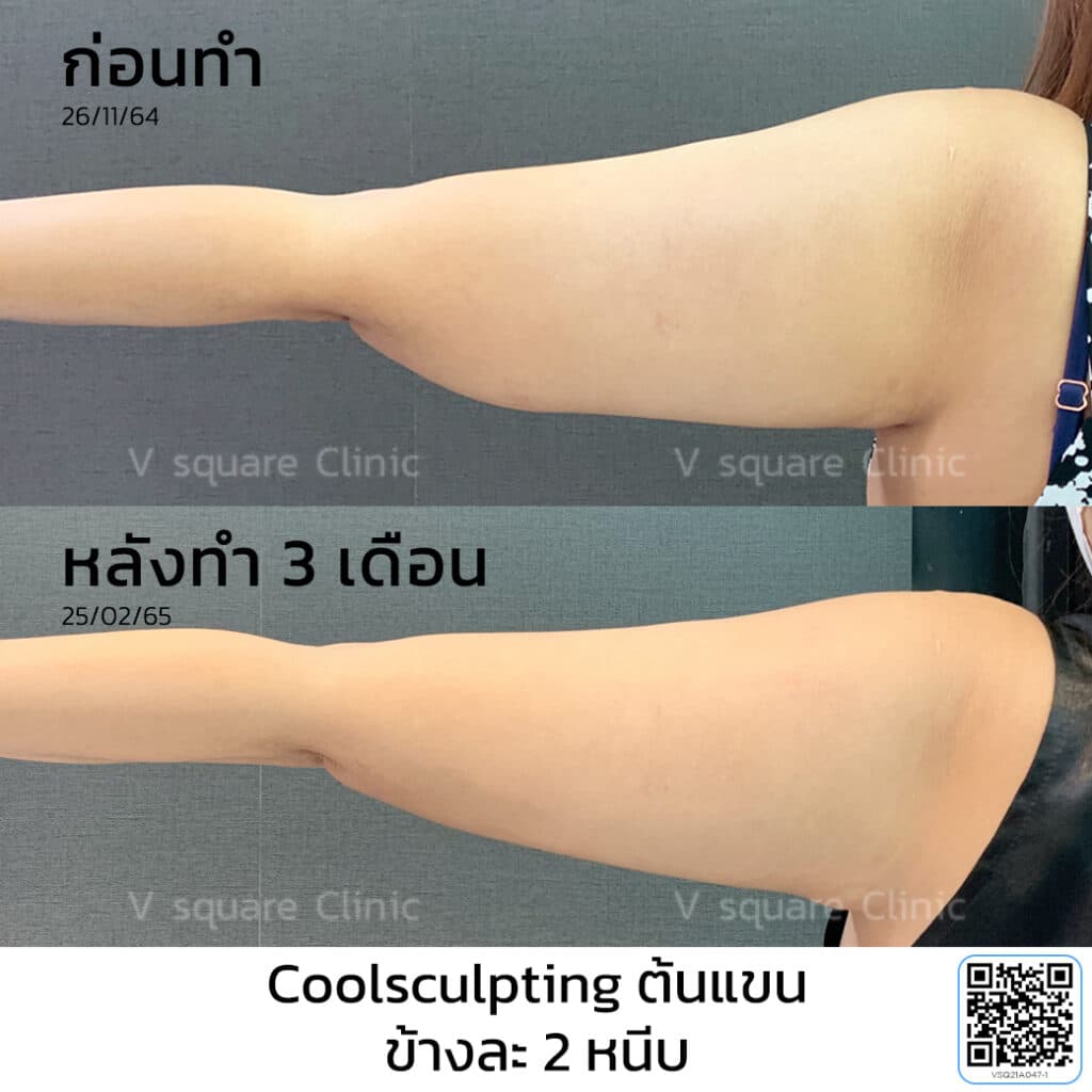 รีวิว Coolsculpting ต้นแขน