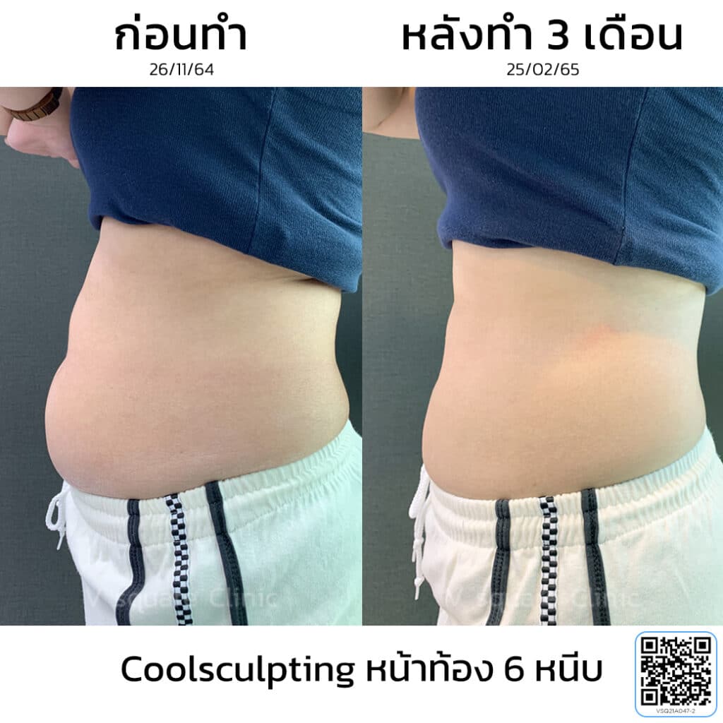 รีวิว Coolsculpting หน้าท้อง