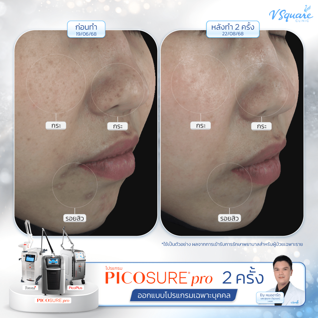 รีวิว Pico กระ โดย นพ.สุรนาถ ดีสุวรรณ์