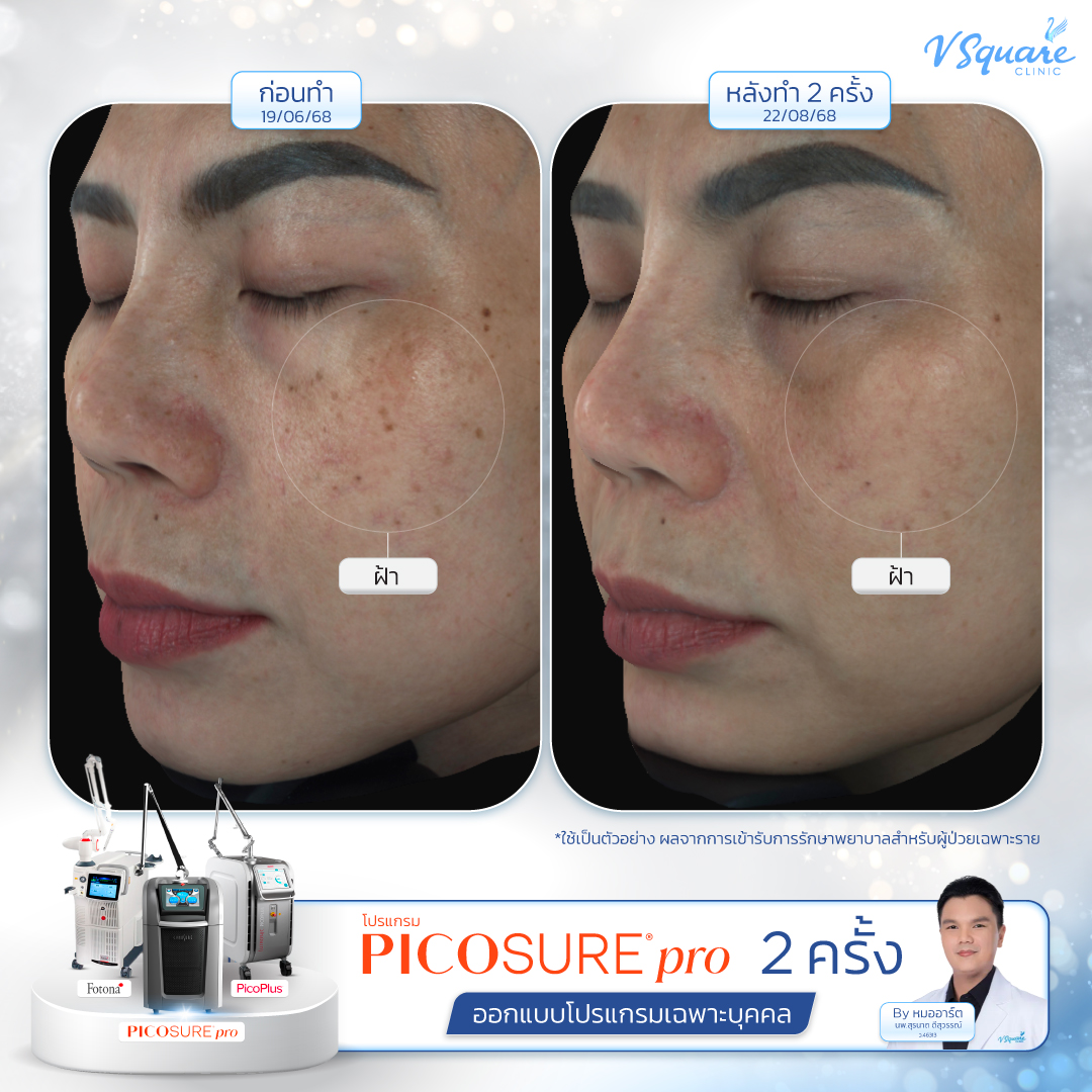 รีวิว ทำ pico ฝ้า นพ.สุรนาถ ดีสุวรรณ์