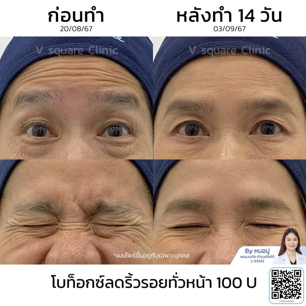 รีวิวฉีดโบท็อกริ้วรอย_คุณชมพู่ โดย หมอปู