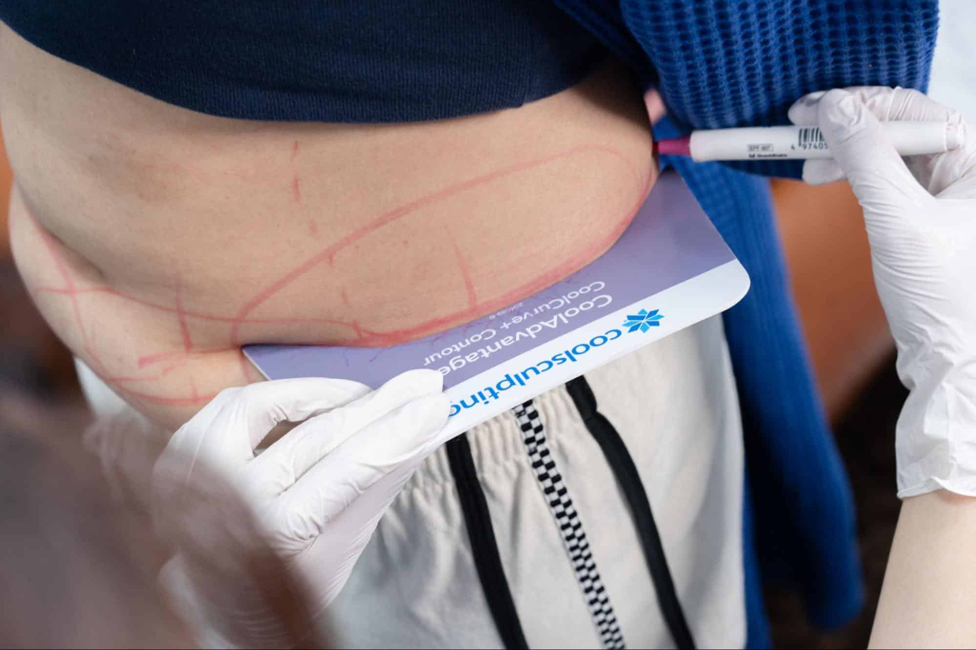 แพทย์มีประสบการณ์ทำ Coolsculpting ที่ไหนดี