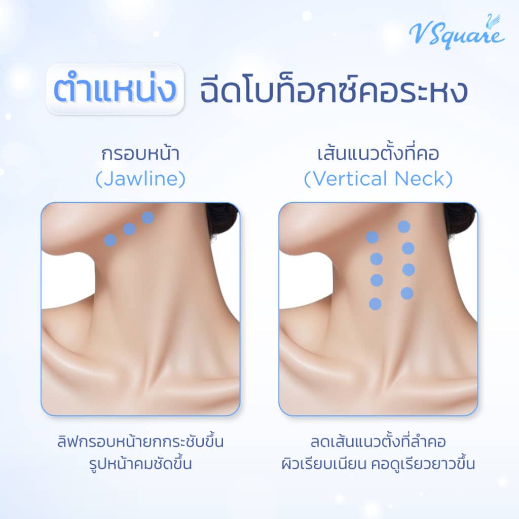 โบท็อกบ่าคอระหง ฉีดตำแหน่งไหน