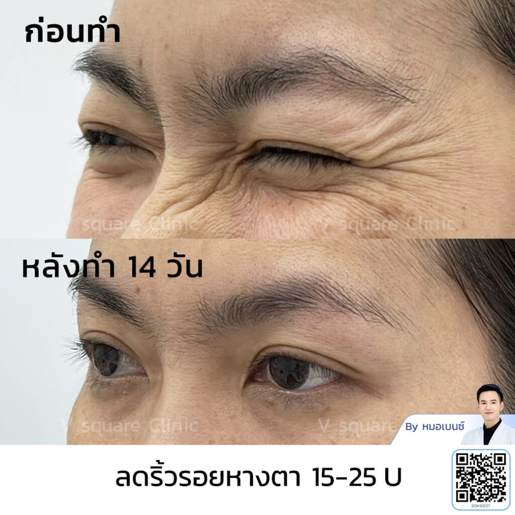 โบท็อกริ้วรอย รีวิว_คุณจุฑามาศ โดย หมอเบนซ์