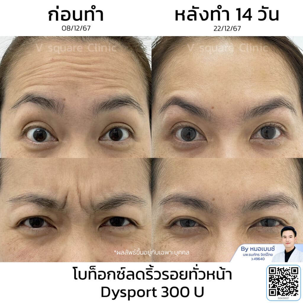โบท็อกริ้วรอย รีวิว_คุณจุฑามาศ โดย หมอเบนซ์