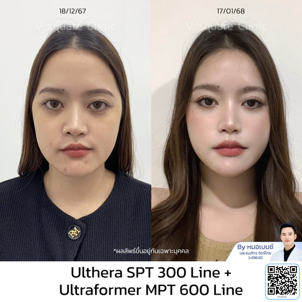 Ulthera รีวิว คุณเฟรนด์ โดยหมอเบนซ์