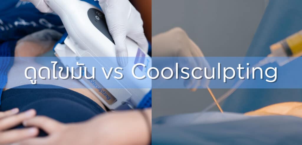 การทำงานดูดไขมัน vs Coolsculpting
