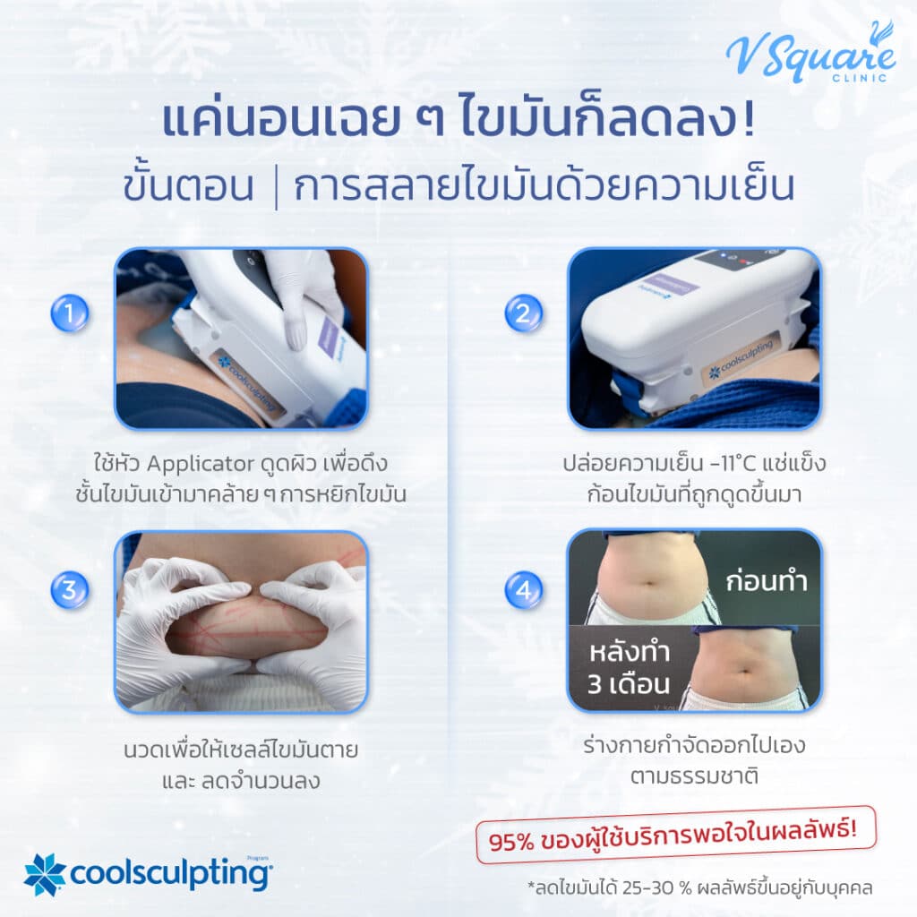 ข้อดี Coolsculpting