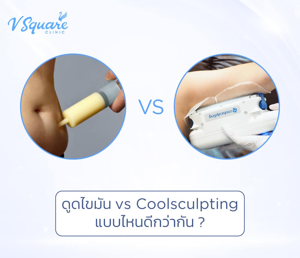 ดูดไขมัน vs Coolsculpting