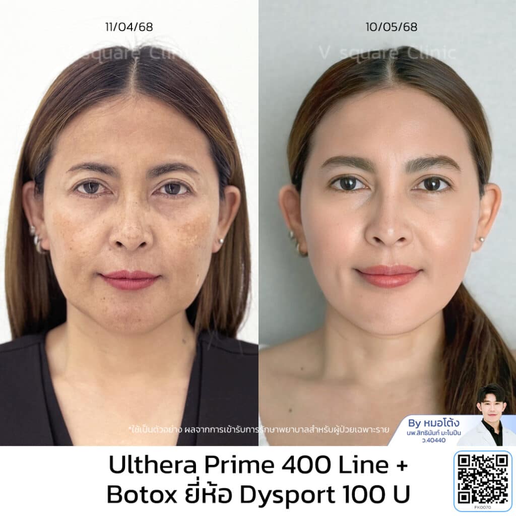 รีวิว Ulthera คุณพลอย โดย นพ.สิทธินันท์ มะโนปีน