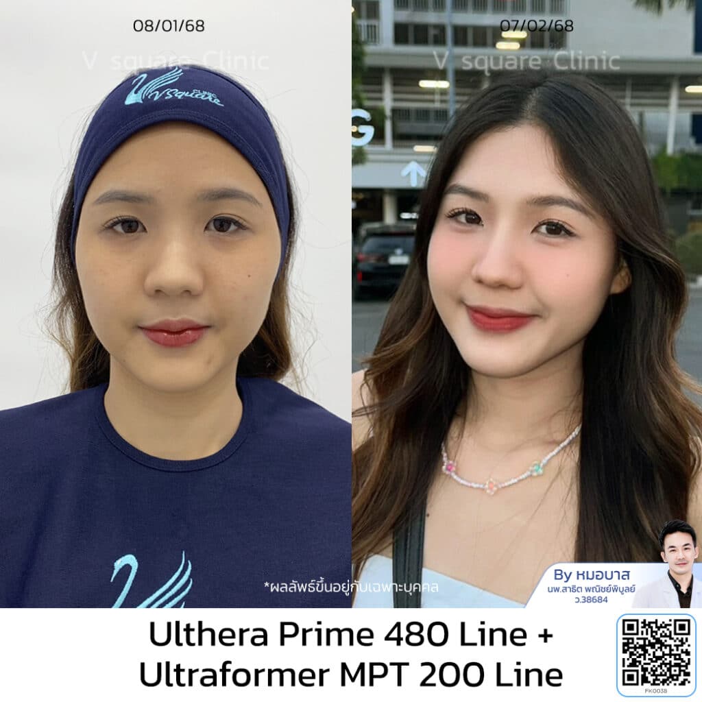 รีวิวทำ Ulthera Prime หมอบาส_คุณเอิร์น โดย หมอบาส