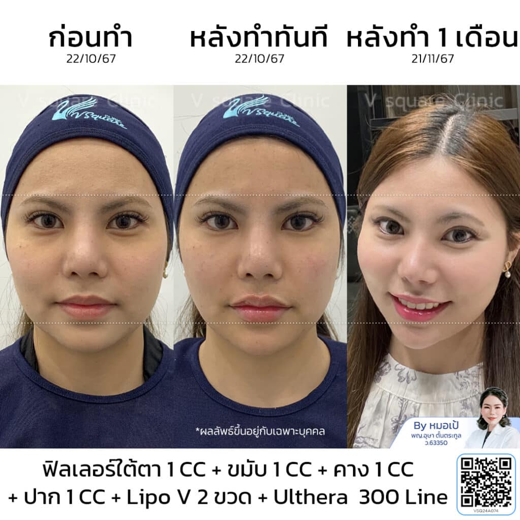 รีวิวทำ Ulthera หมอเป้ คุณเตย โดย หมอ เป้