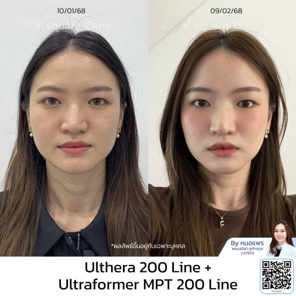รีวิวทำ Ulthera หมอแพร_คุณฟิว โดย หมอแพร