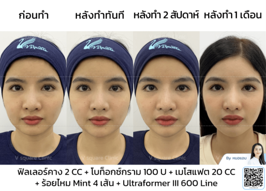 รีวิวลิฟกรอบหน้ากับโบกราม_คุณซานตี้ โดย หมอ แอม