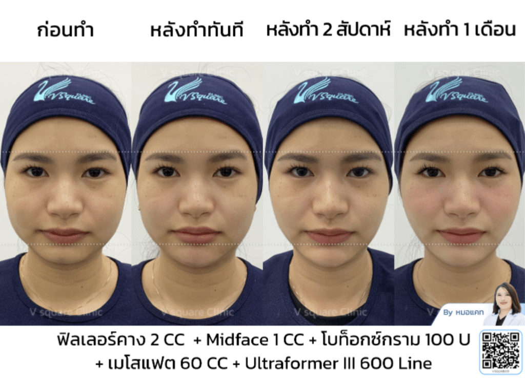 รีวิวลิฟกรอบหน้ากับโบกราม_คุณเนย โดย หมอ แคท