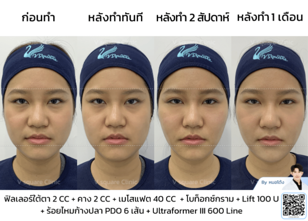 รีวิวลิฟกรอบหน้ากับโบกราม_คุณแจน โดย หมอ โต้ง