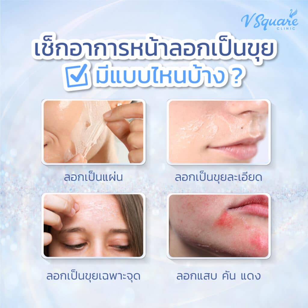 อาการหน้าลอกเป็นขุย
