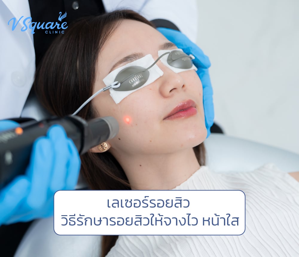 เลเซอร์รอยสิว