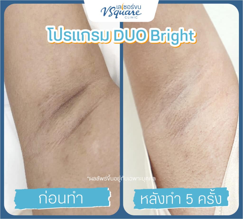เลเซอร์รักแร้ขาว รีวิว