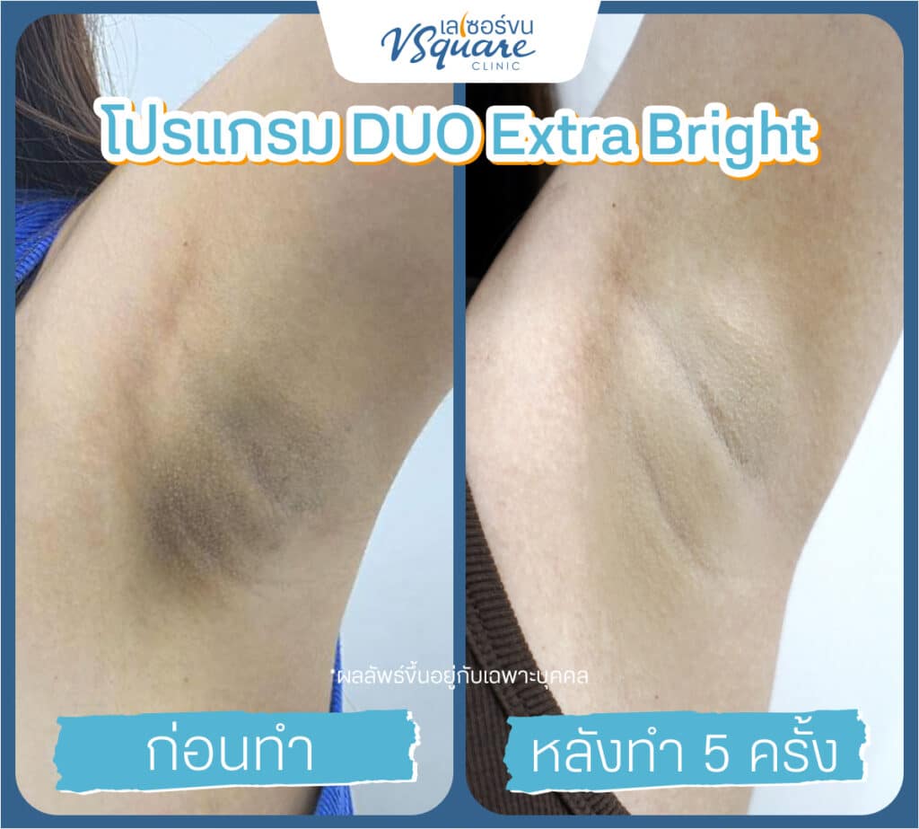 เลเซอร์รักแร้ขาว รีวิว