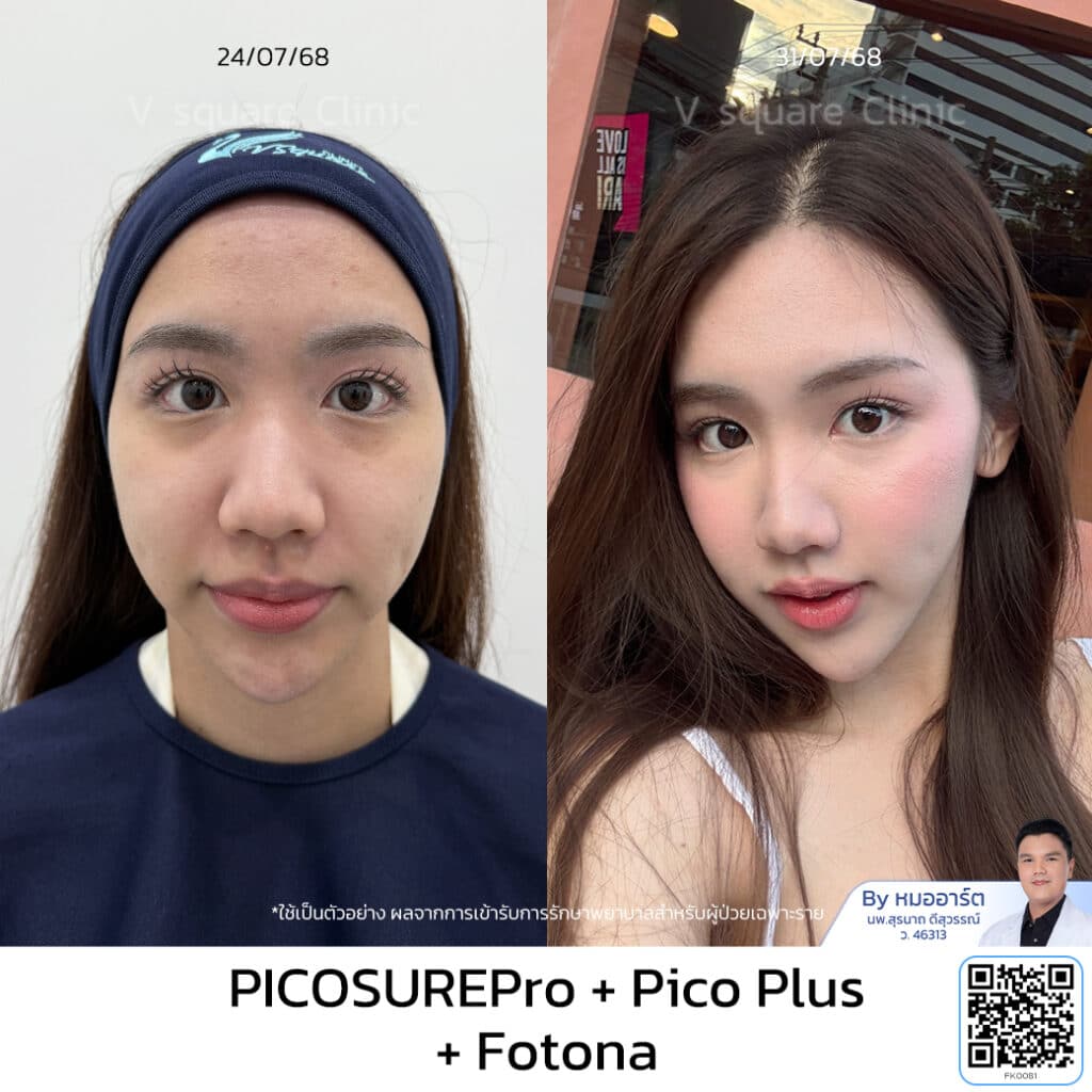 รีวิว Rejuvenation Laser_คุณเนย โดยหมออาร์ต