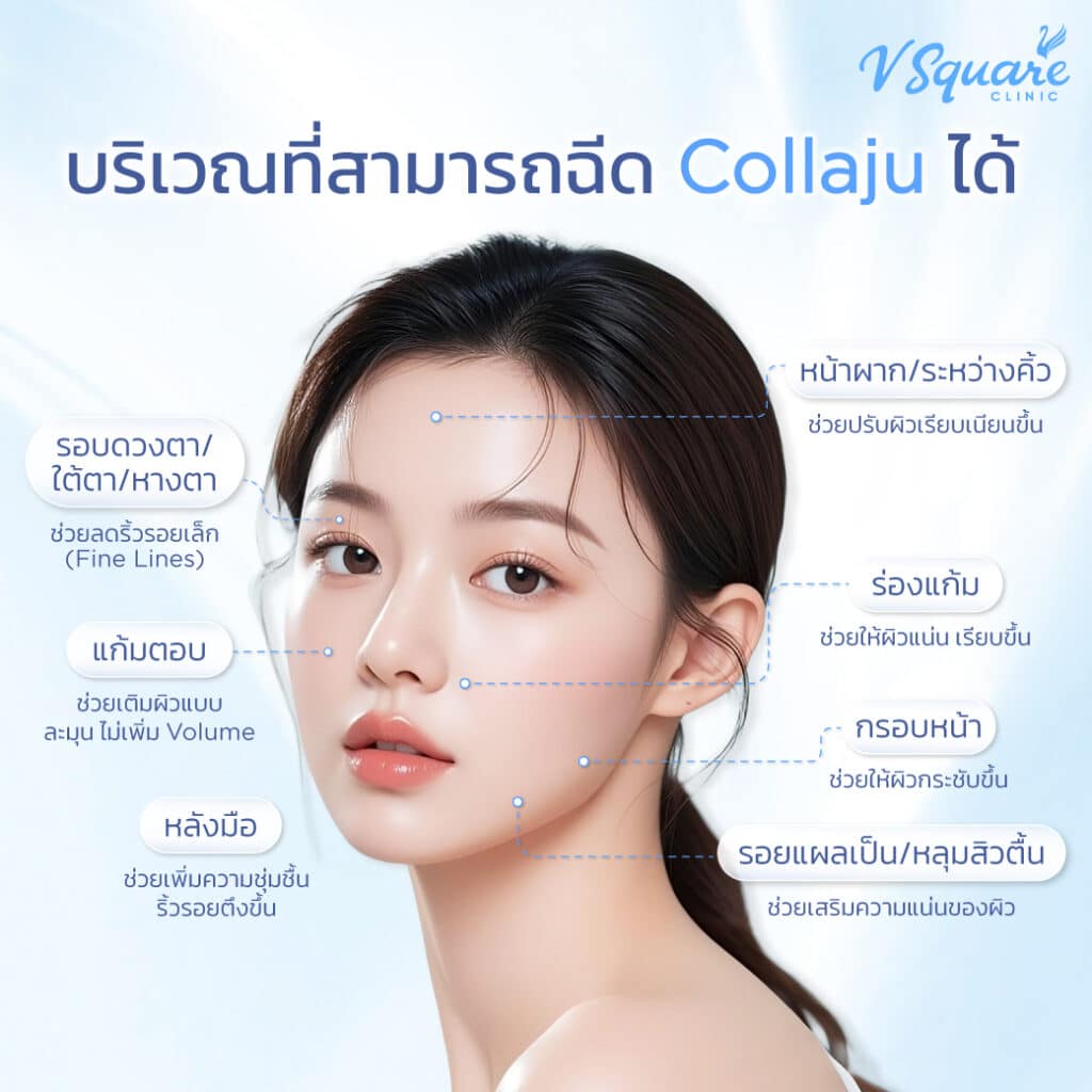 ฉีด Collaju ตำแหน่งไหนบ้าง