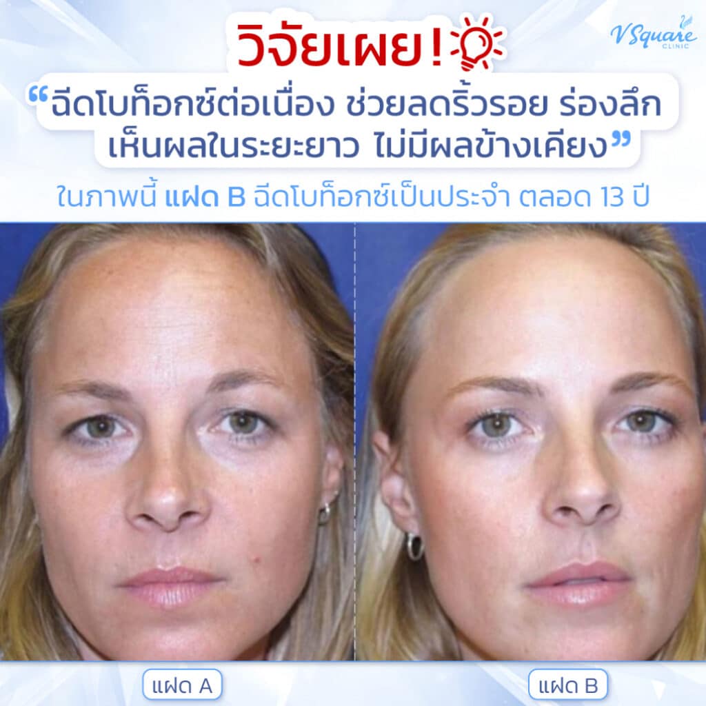 ฉีดโบท็อก ดีไหม