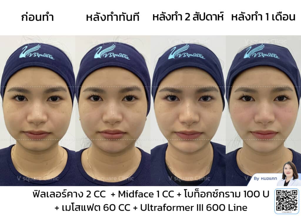 รีวิวฉีดโบท็อกซ์กราม_คุณเนย _โดยหมอแคท