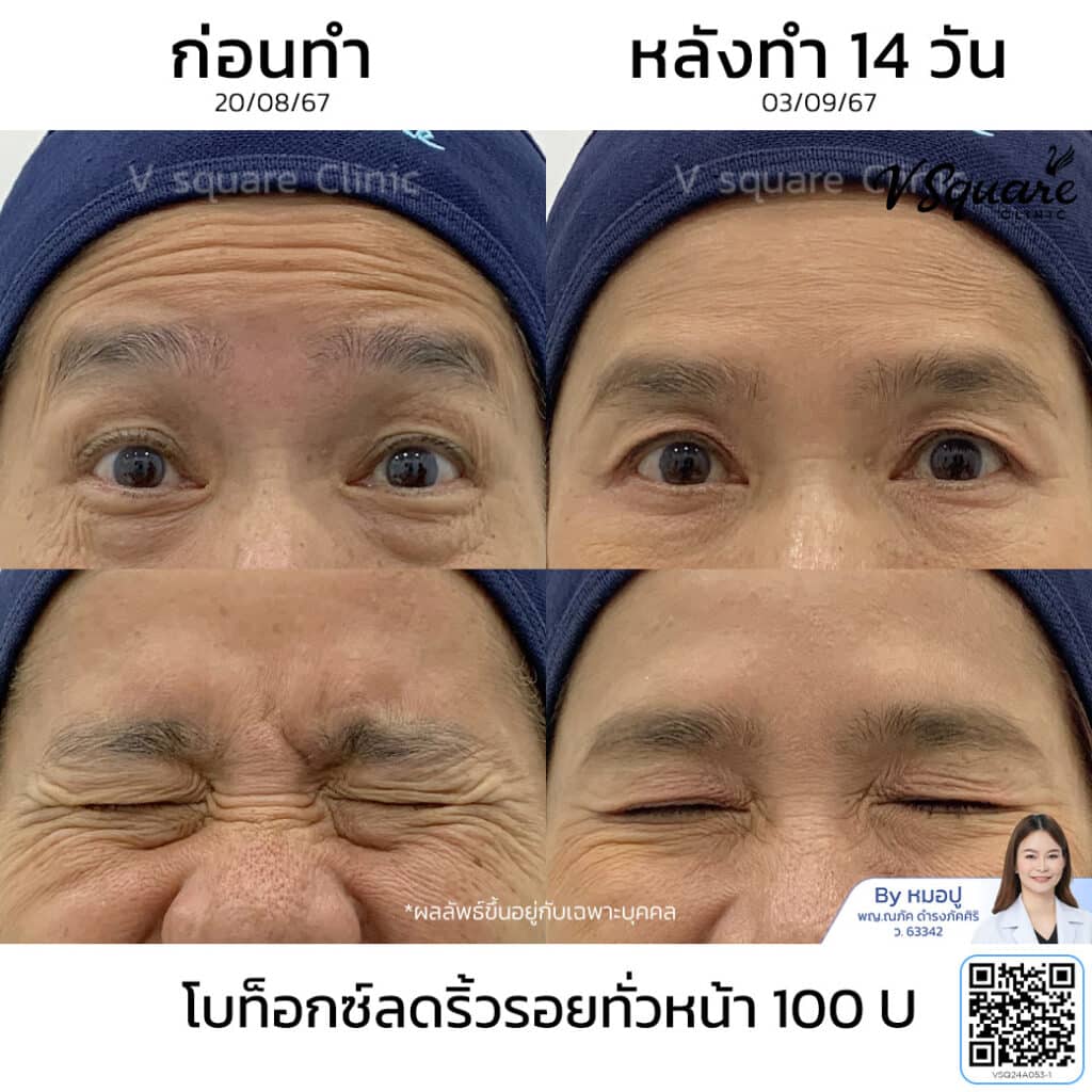 รีวิวฉีดโบท็อกตีนกา_คุณชมพู่_โดยหมอปู