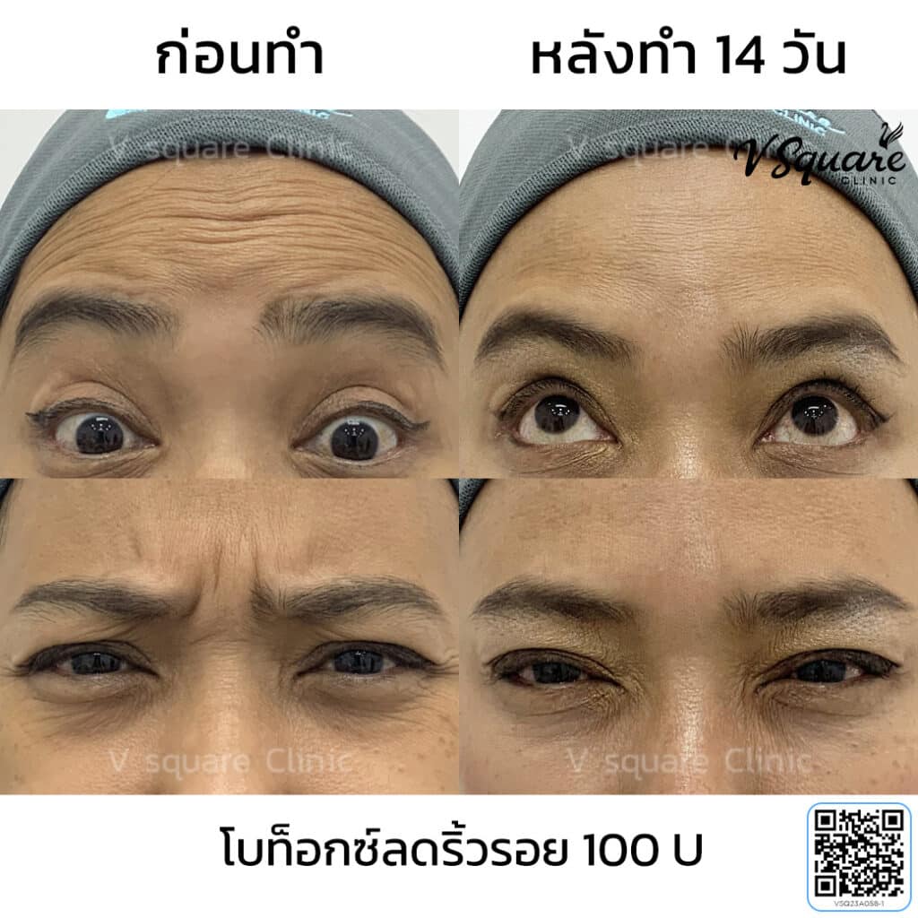 รีวิวฉีดโบท็อกตีนกา_คุณวิกกี้