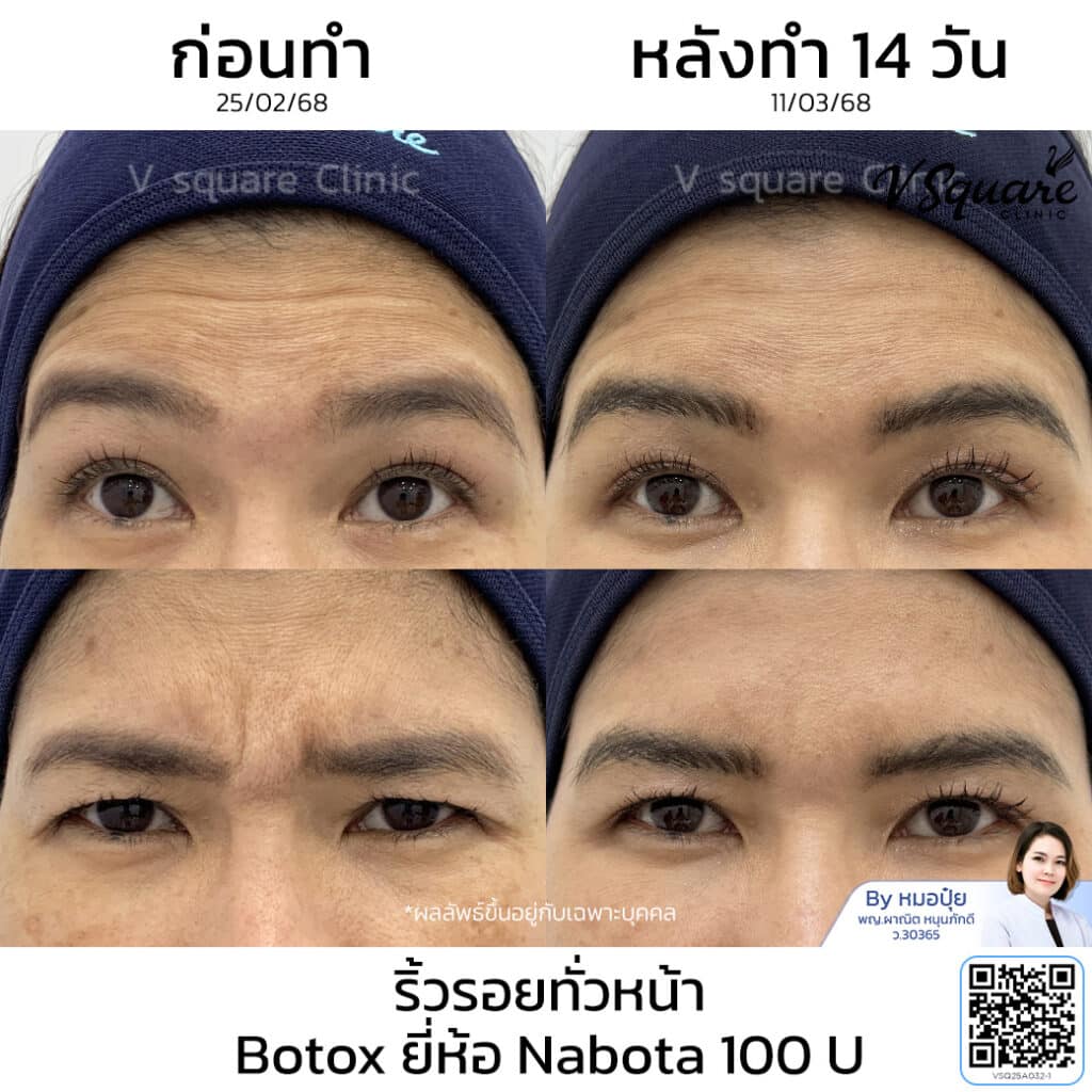 รีวิวฉีดโบท็อกตีนกา_คุณหมวย_โดยหมอปุ๋ย