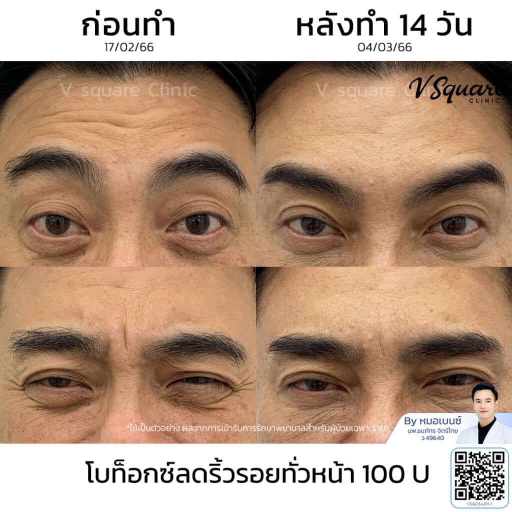 รีวิวฉีดโบท็อกตีนกา_คุณเก่ง_โดยหมอเบนซ์