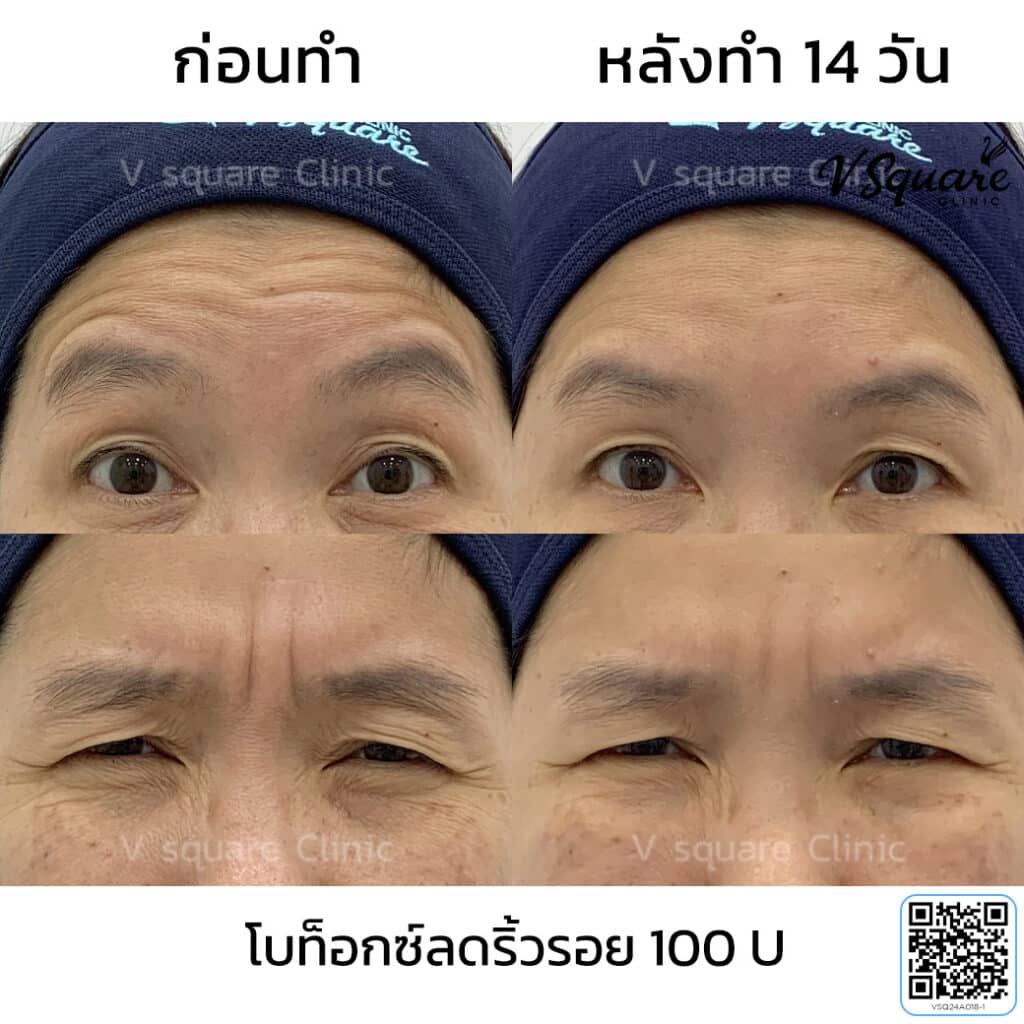 รีวิวฉีดโบท็อกตีนกา_แม่อ้อย