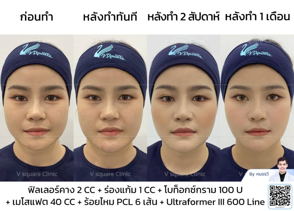 รีวิวฉีดโบท็อกลดกราม_คุณหญิง_โดยหมอรวี