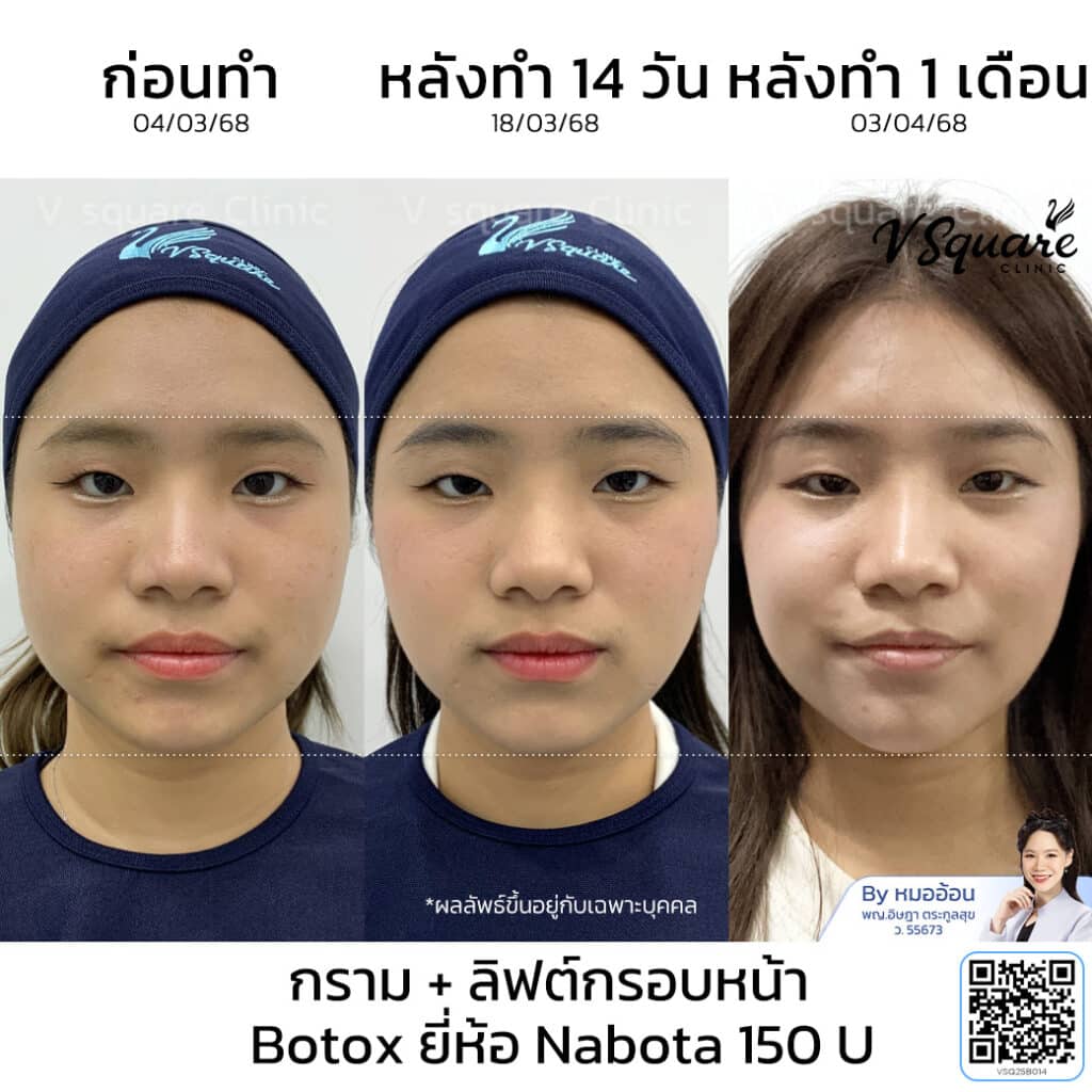 รีวิวฉีดโบลิฟต์กรอบหน้า_คุณนิ้งค์_โดยหมออ้อน