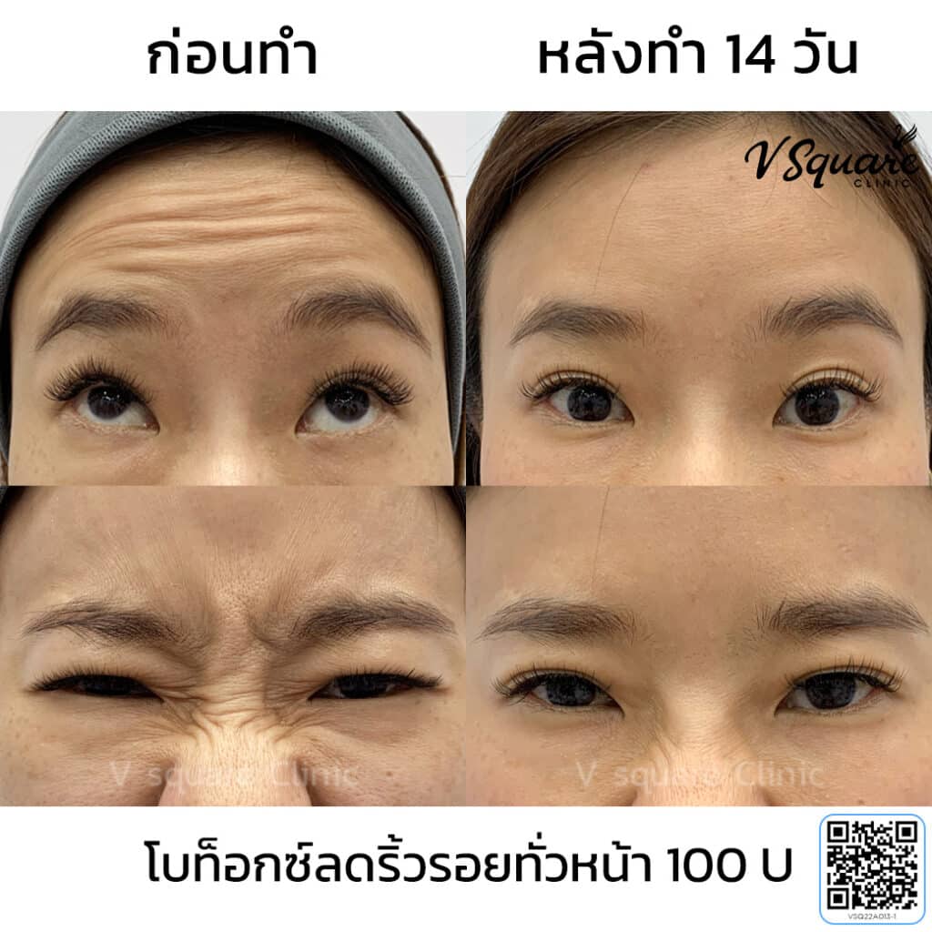 โบท็อกริ้วรอย_คุณแสง