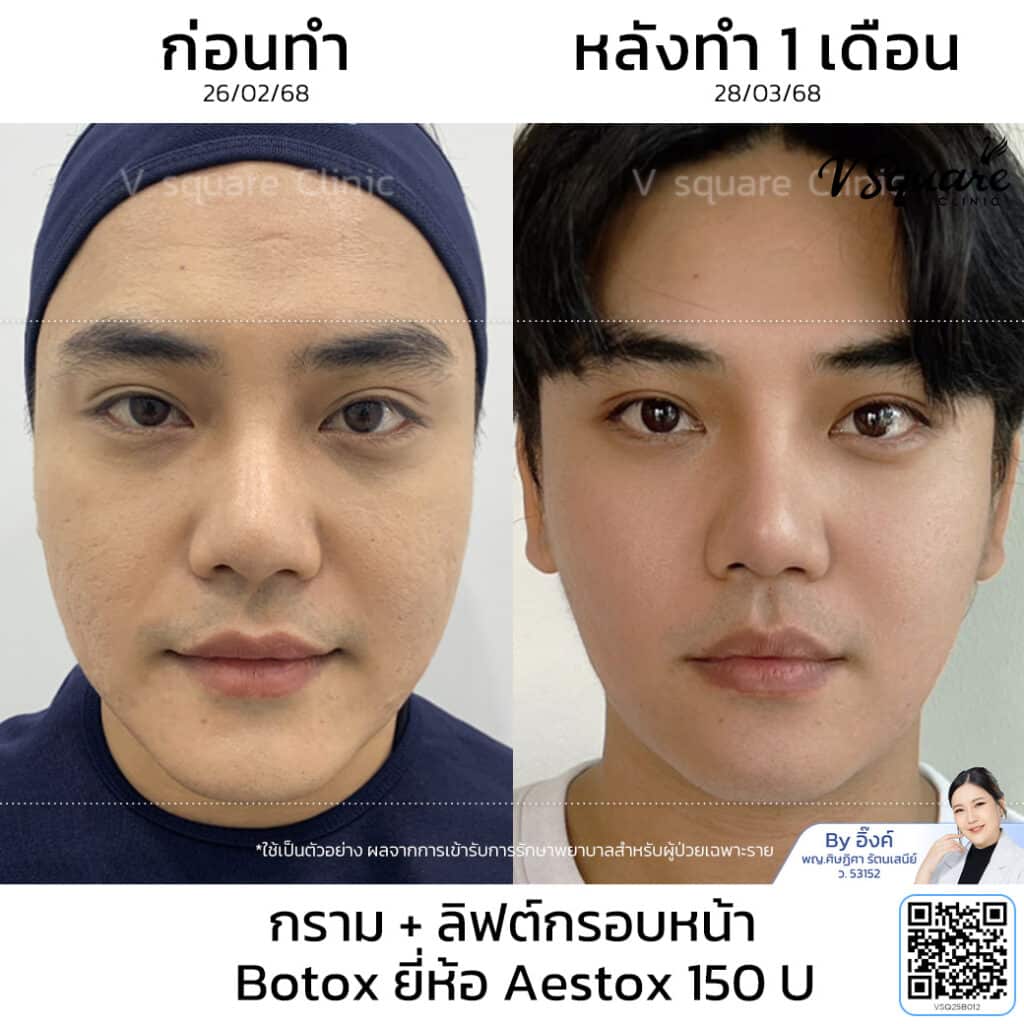 โบท็อกลิฟกรอบหน้า_โย_โดยหมออิ๊งค์