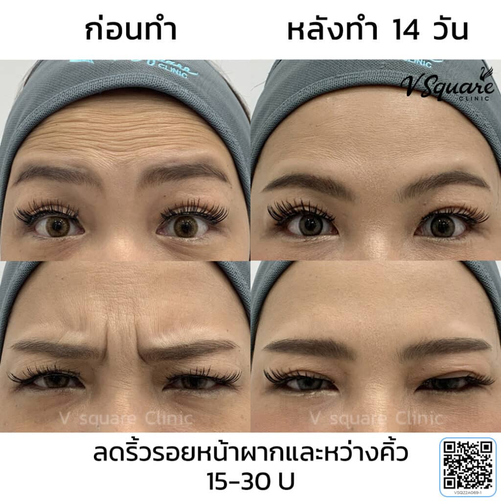 โบท็อกหน้าผาก_คุณออย
