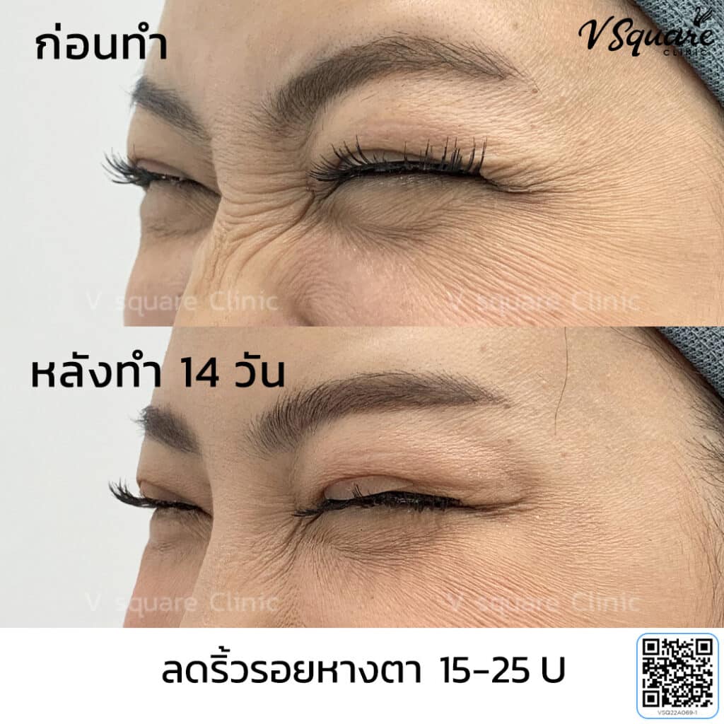 โบท็อกหางตา_คุณออย