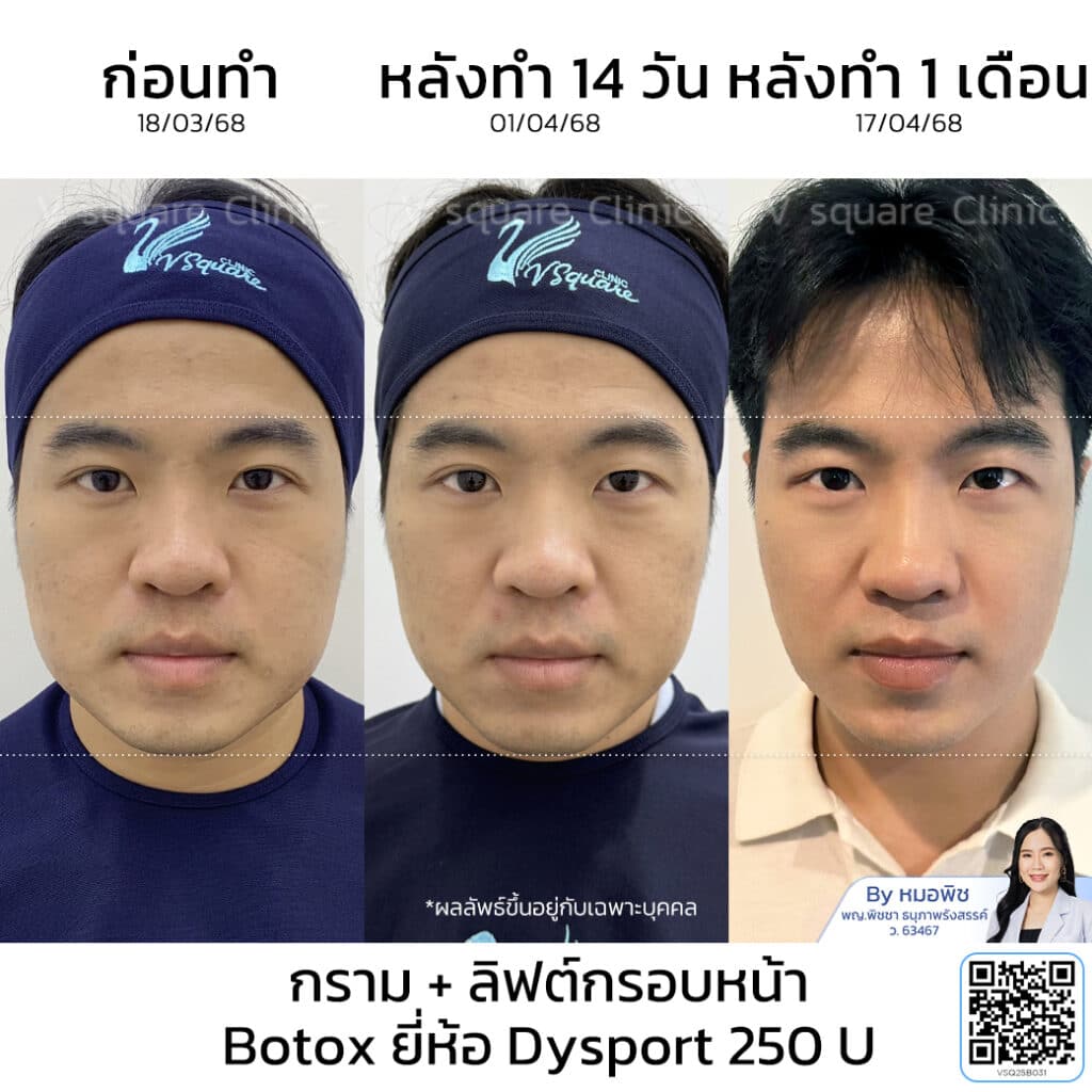 Dysport Botox รีวิว_คุณเก้า_โดยหมอพิช