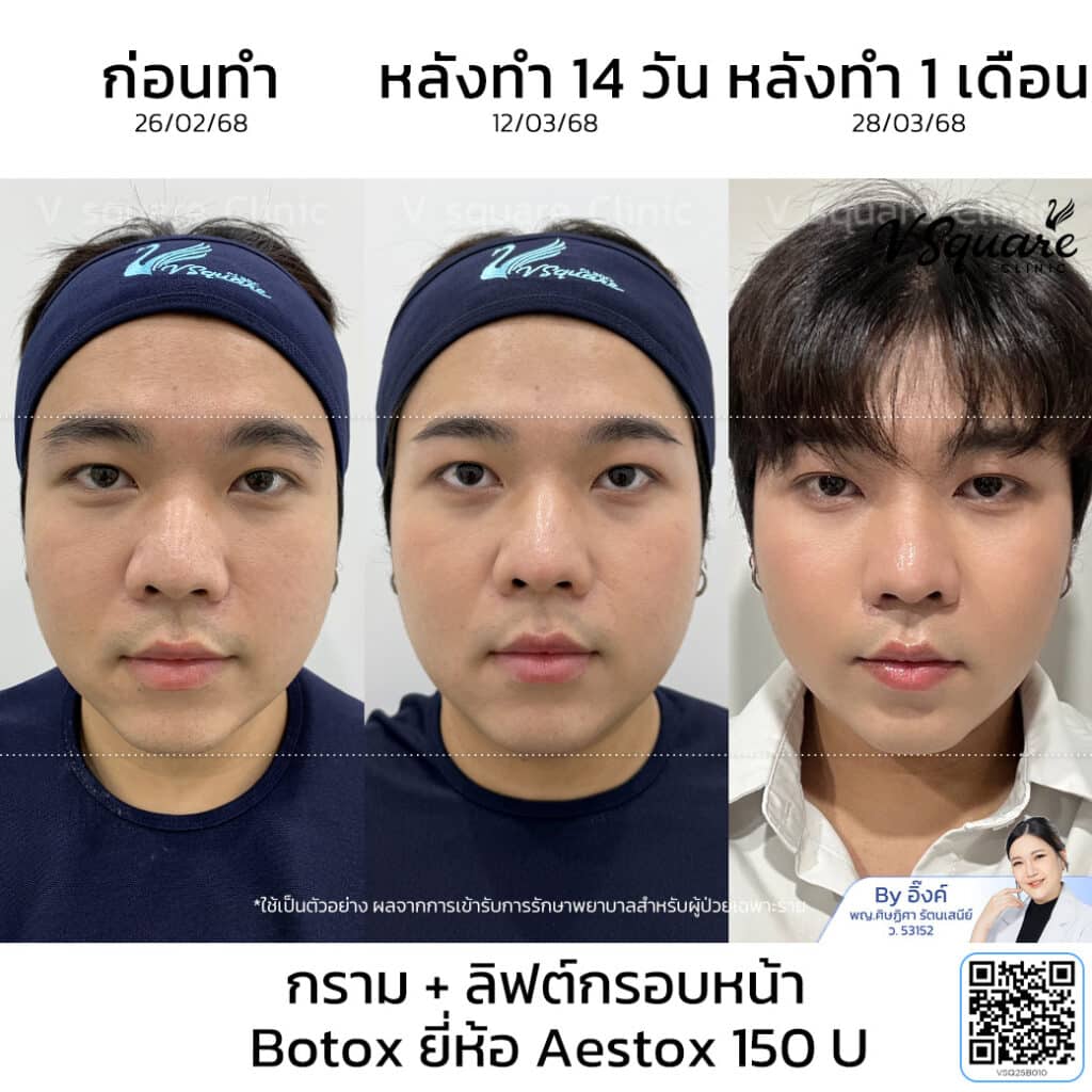 รีวิว Aestox Botox_คุณรุ่ง_โดยหมออิ๊งค์