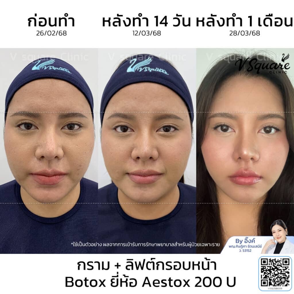 รีวิว Aestox Botox_น้องแพม_โดยหมออิ๊งค์