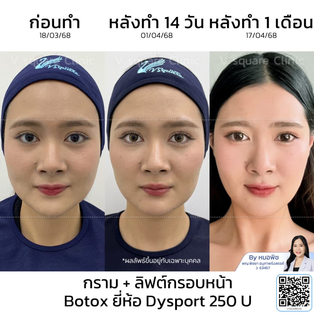 รีวิว Dysport botox คุณฟ้า_โดยหมอพิช