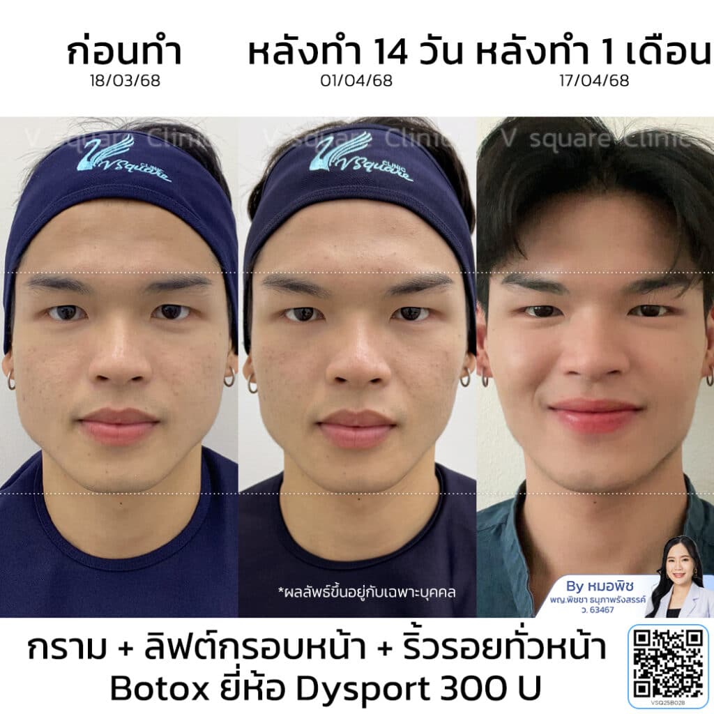 รีวิวผลลัพธ์ Dysport Botox_คุณบอส_โดยหมอพิช